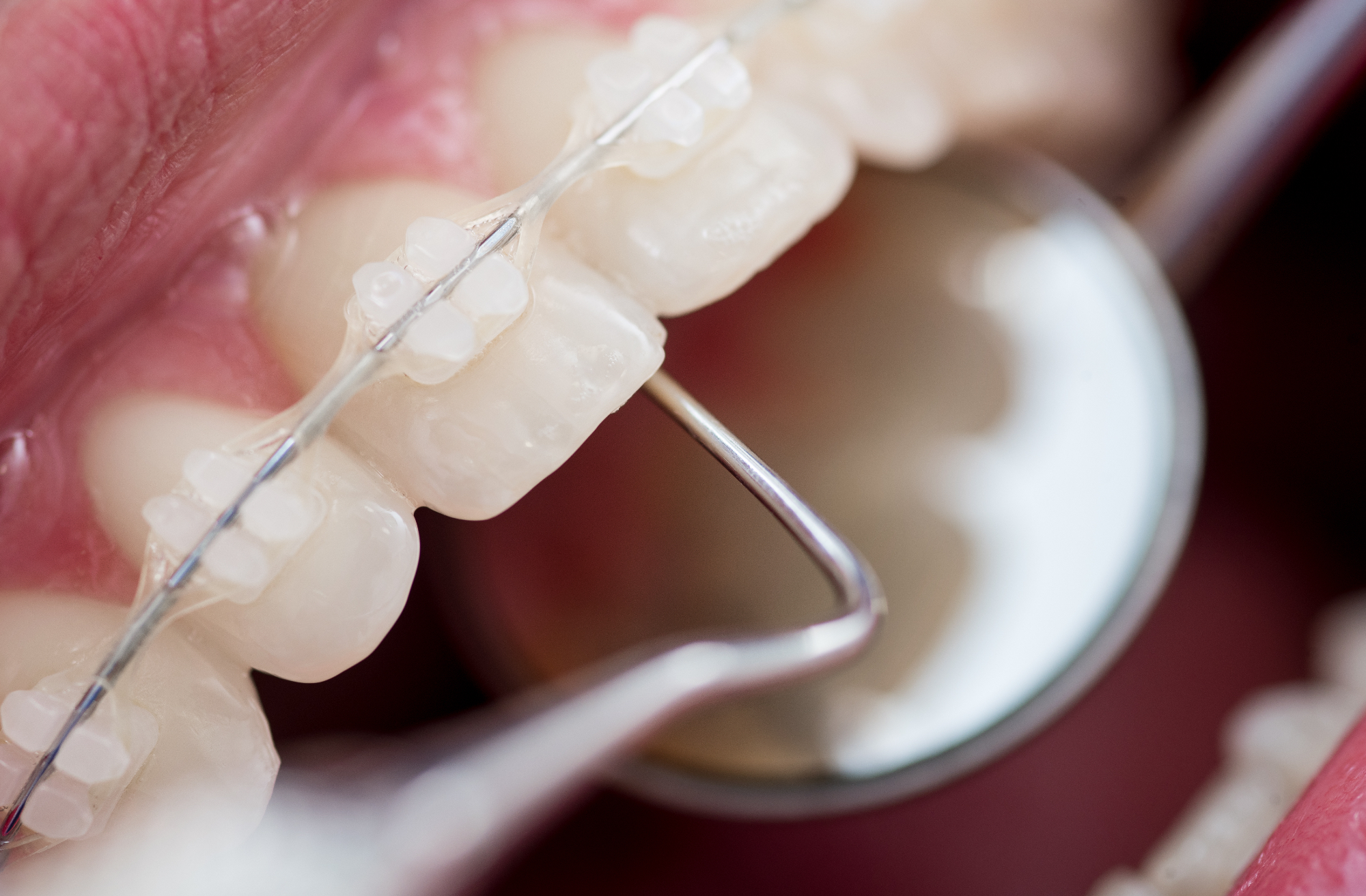 Kakšno vrsto zobnega aparata vam bo predlagal ortodont?